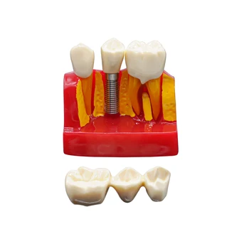 1set Dantų Mokymo Implantas Analizė Karūna Tiltas Nuimamas Demonstravimo Dantų Modelis