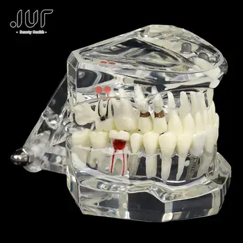 Karšto Pardavimo Dantų Implantai Dantų Ligos Modelis Medicinos Mokymo Burnos Sveikatos Priežiūros, Mokslo, Dantų Ligos Mokymo Studijų